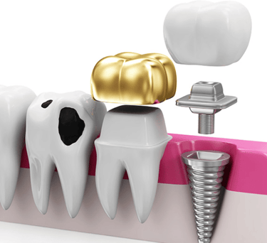restorative dental procedures