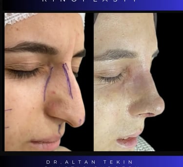 rhinoplasty before after photos in Antalya, Turkey