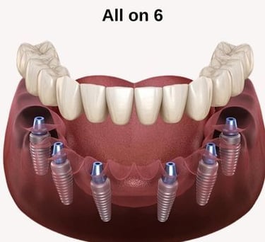 all on six dental implants
