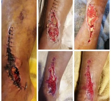 Una progresión de las etapas de cicatrización de heridas quirúrgicas y recuperación de úlceras.