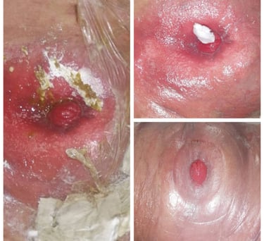colostomia ileostomia estomas curacion educacion estomas