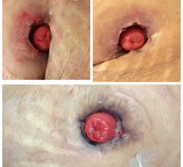 colostomía ileostomía estoma de eliminacion complicación quirúrgica