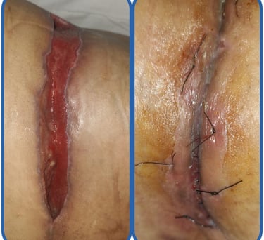 Herida quirurgica cerrada con terapia avanzada de heridas