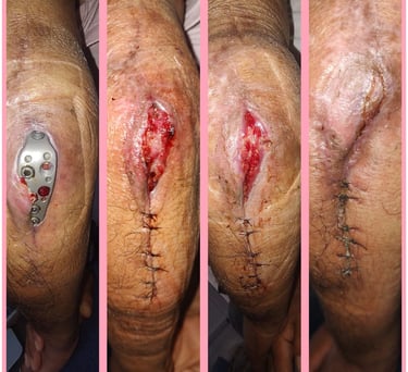 dehiscencia de herida quirurgica curacion de heridas cicatrizacion