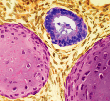 Testis kanserini gösteren bir çizim