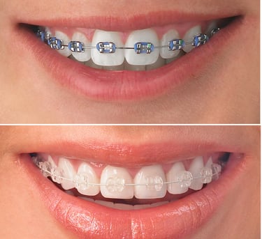 Orthodontic Treatment at dentosculpt