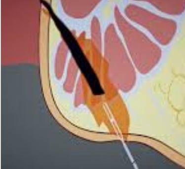 Anal fissures and fistulas: Treatment without surgery
