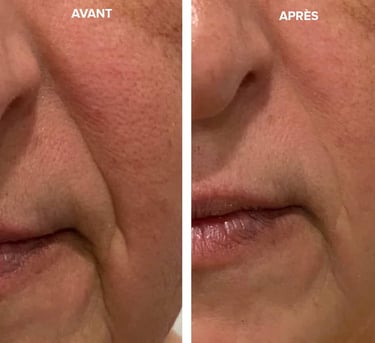 avant apres radiofrequence