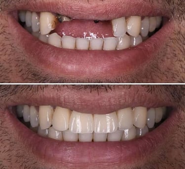 missing teeth, teeth fracture, replacement of missing teeth, dental implants for missing teeth