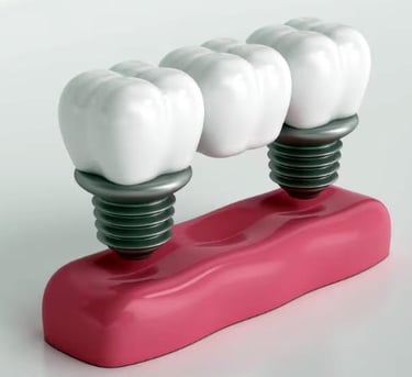 Implant supported bridge
