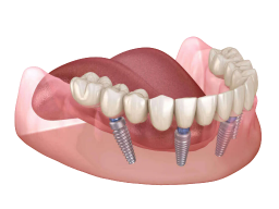 All-on-4 Türkei İzmir — festsitzende Vollversorgung auf vier Implantaten bei Designed Smiles