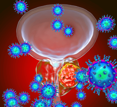 Prostat kanserini anlatan bir çizim.