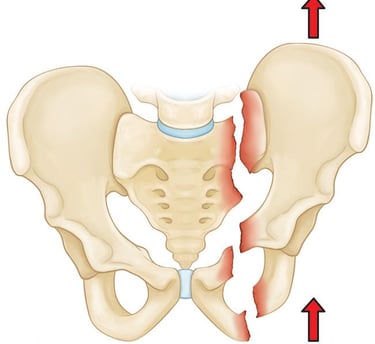 Dr.Rajinikanth's ortho clinic pelvic fractures