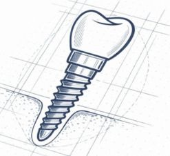 Implantes dentários em Goiânia realizado com planejamento avançado