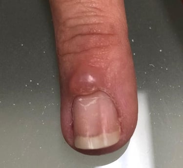 Cisto mixoide, Unhas, Salvador/ahia