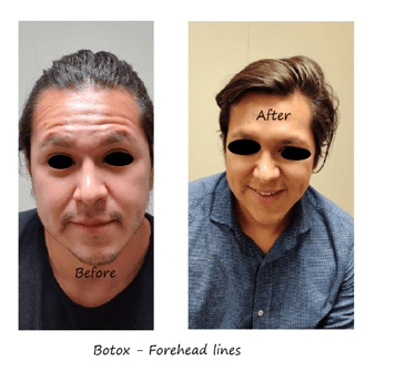 Before and after photos of botox in the forehead - reduced wrinkles and natural eyebrow shape.