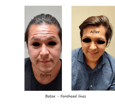 Before and after photos of botox in the forehead - reduced wrinkles and natural eyebrow shape.