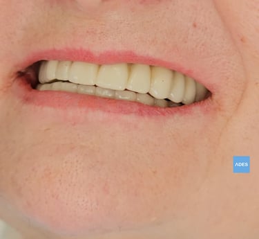 Sonrisa después de implantes en Badajoz