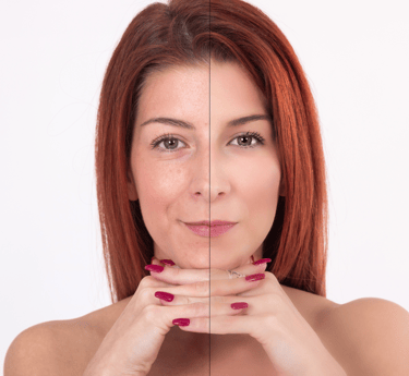 Botox Before and After Results