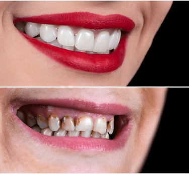 Full Mouth Rehabilitation Treatment Result by Dr Dhirende