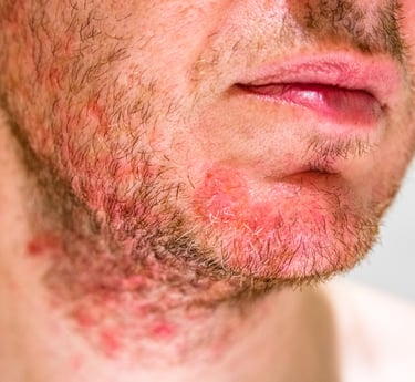 Folliculitis