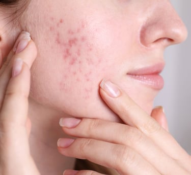 Rosacea