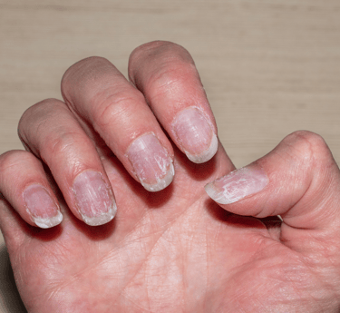 Brittle Nails