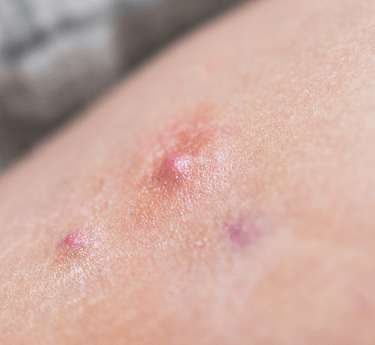 Hidradenitis Suppurativa