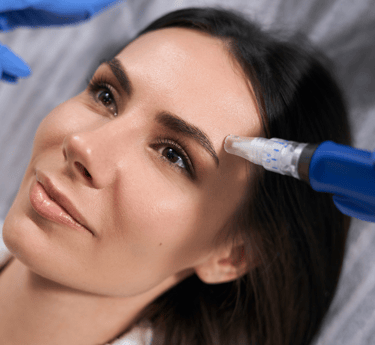 Microneedling