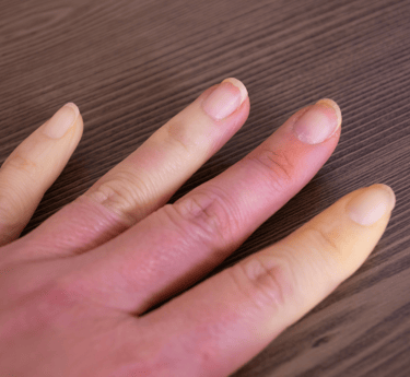Finger Nail Discolouration