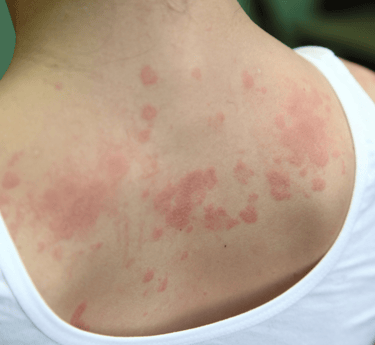Urticaria