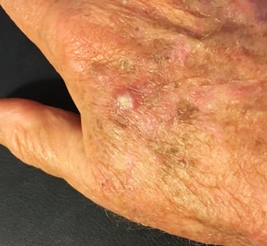 Actinic Keratoses