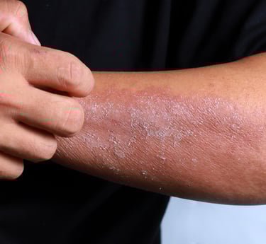 Dry Skin
