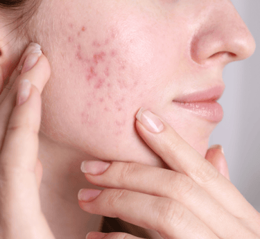 Rosacea