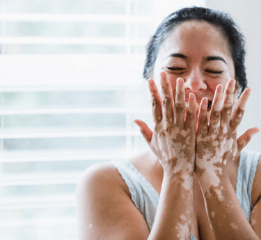 Vitiligo