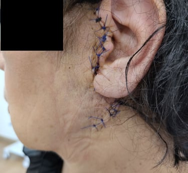 παρωτίδα όγκος σιελογόνοι αδένες Καβάλα παρωτιδεκτομή