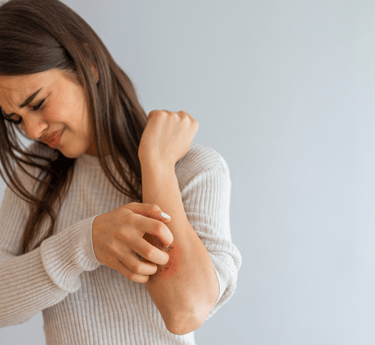 Eczema