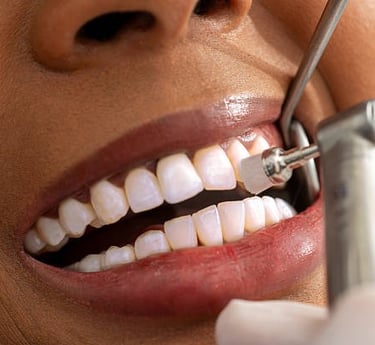 Teeth cleaning greenville SC