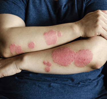 Eczema & Psoriasis Care