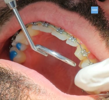 Tratamiento dental para adultos en Badajoz