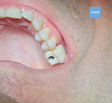 Implantes dentales en Clínica Dental ADES