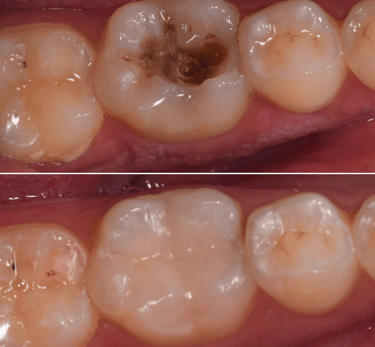 Deep teeth cavity treated with tooth colored filling of bonded composite resin by best dentist in malad west
