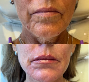 preenchimento labial viva clinica integrada estética avançada