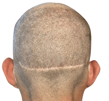 un homme aillant une cicatrice due à une greffe de cheveux