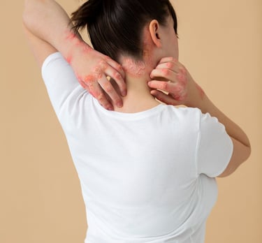 Best Ayurvedic Treatment for Psoriasis in Vijayawada