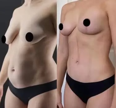breast reduction before after photos