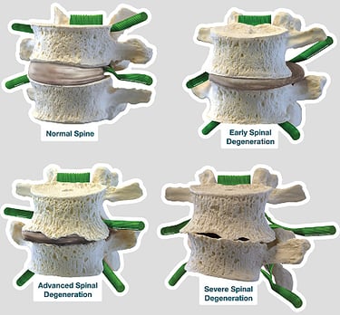 Envelhecimento da coluna vertebral esquematicamente
