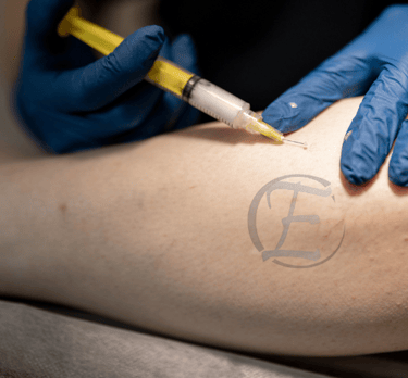 ESCLEROTERAPIA