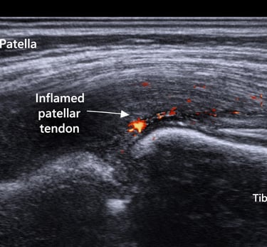 echographie tendon genou inflammation