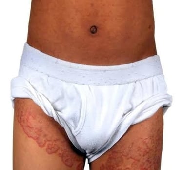 Person in underwear displaying stomach rash, in need of tinea treatment in Vadodara